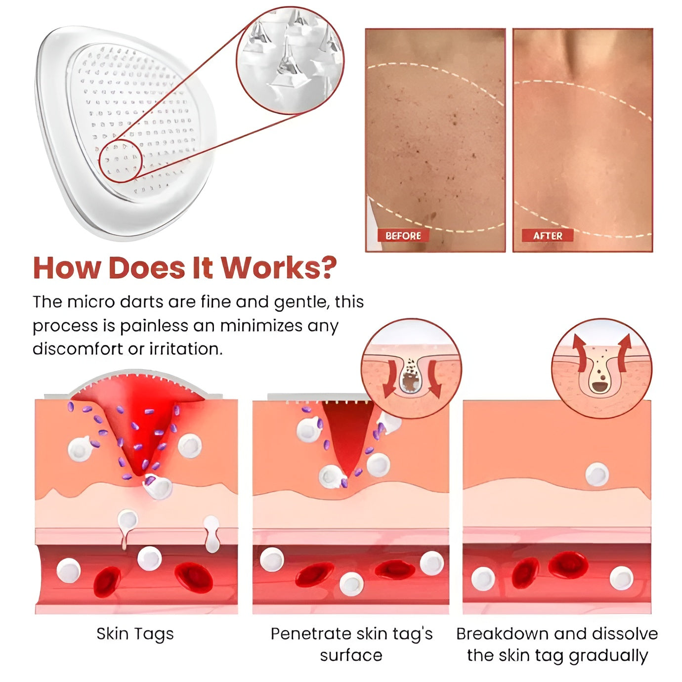 DermaSmooth Tag, Pimple & Acne Removal Patches